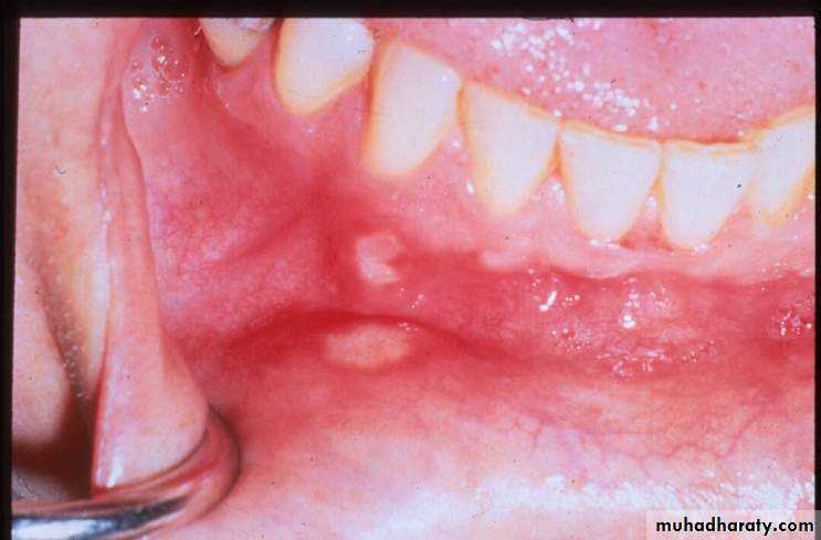 acute periodontitis