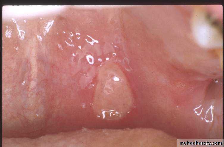 acute periodontitis