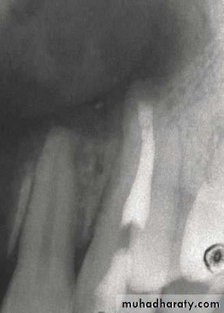 endodontic surgery