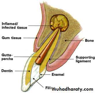 endodontic surgery