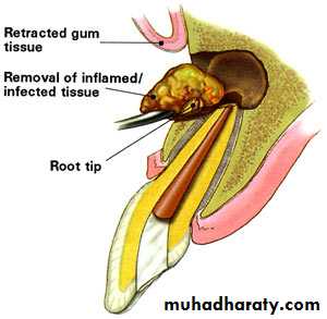 endodontic surgery