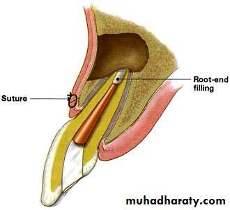 endodontic surgery