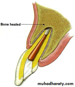endodontic surgery