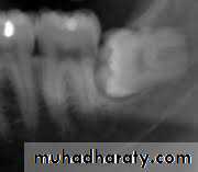 Impaction