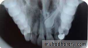 Impaction