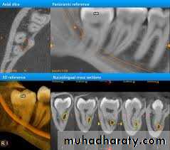 Impaction