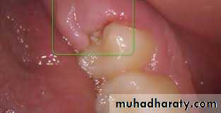 Impaction