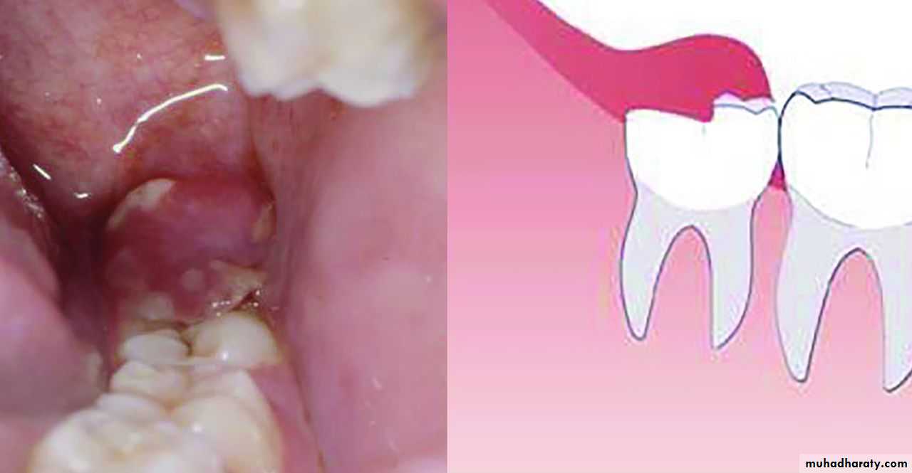 Impaction