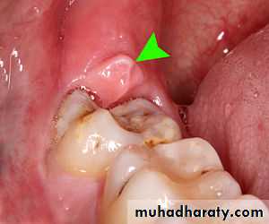 Impaction