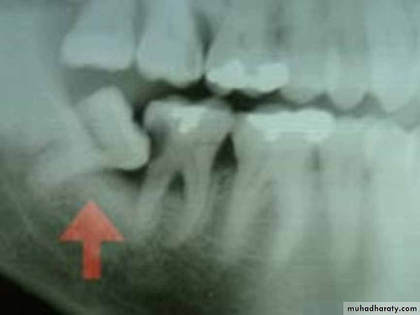 Impaction