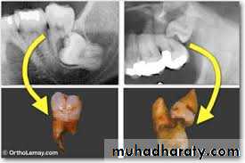Impaction