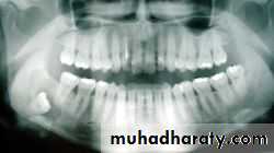 Impaction