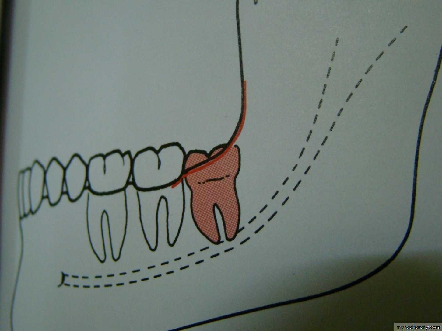 Impaction