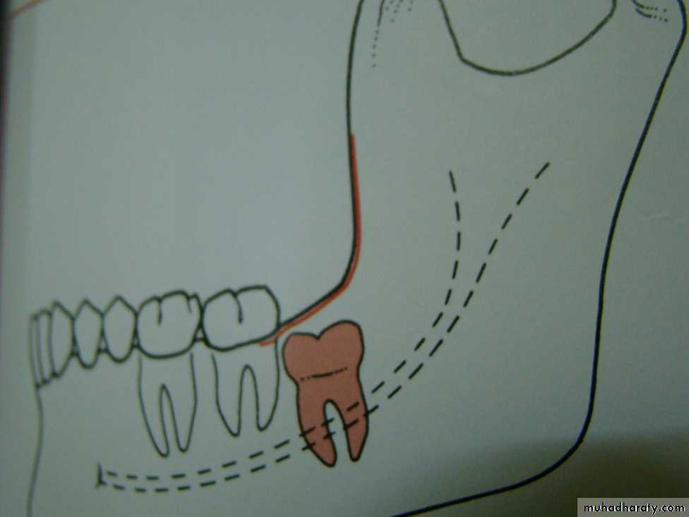 Impaction