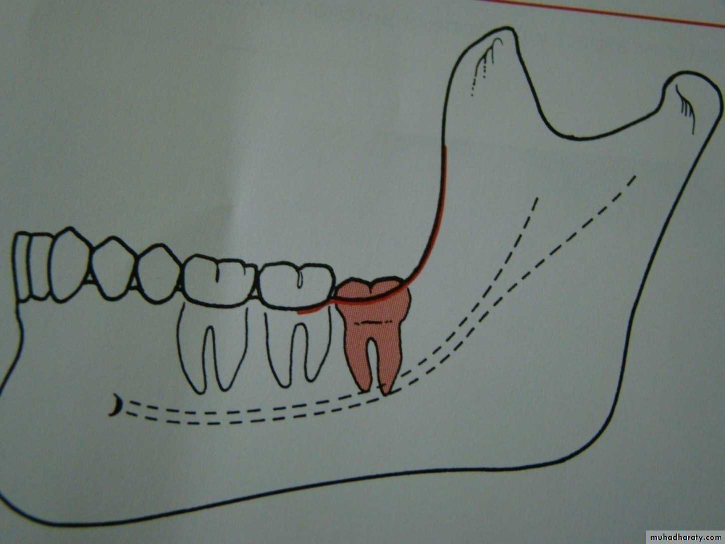 Impaction