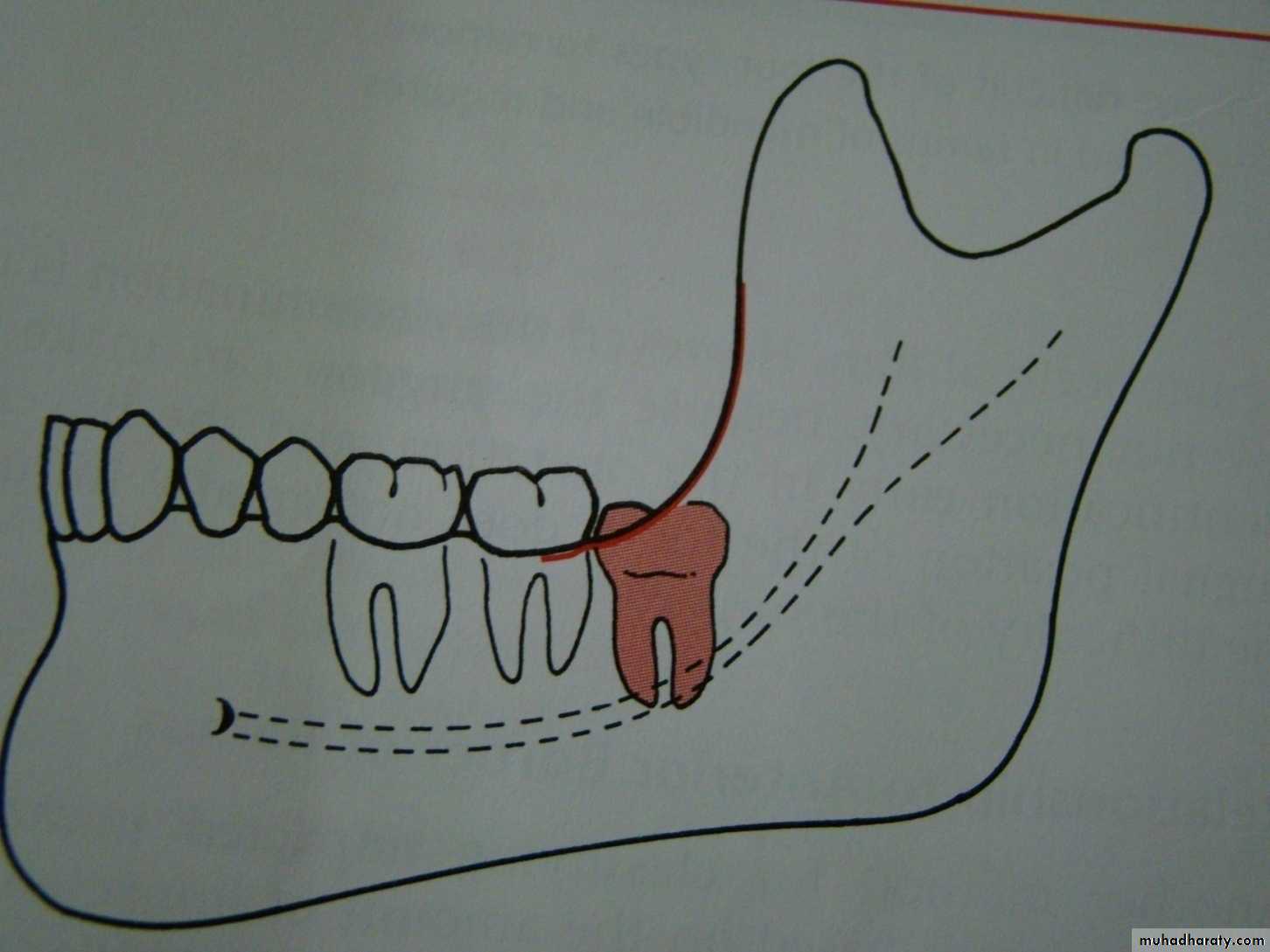 Impaction