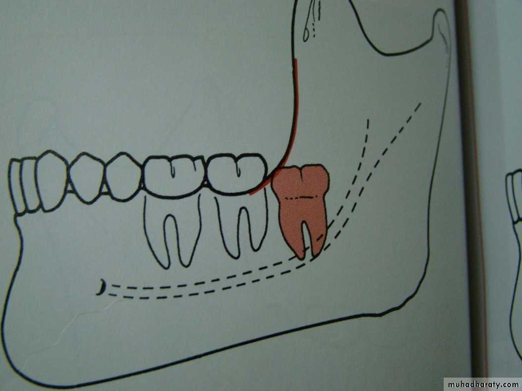 Impaction