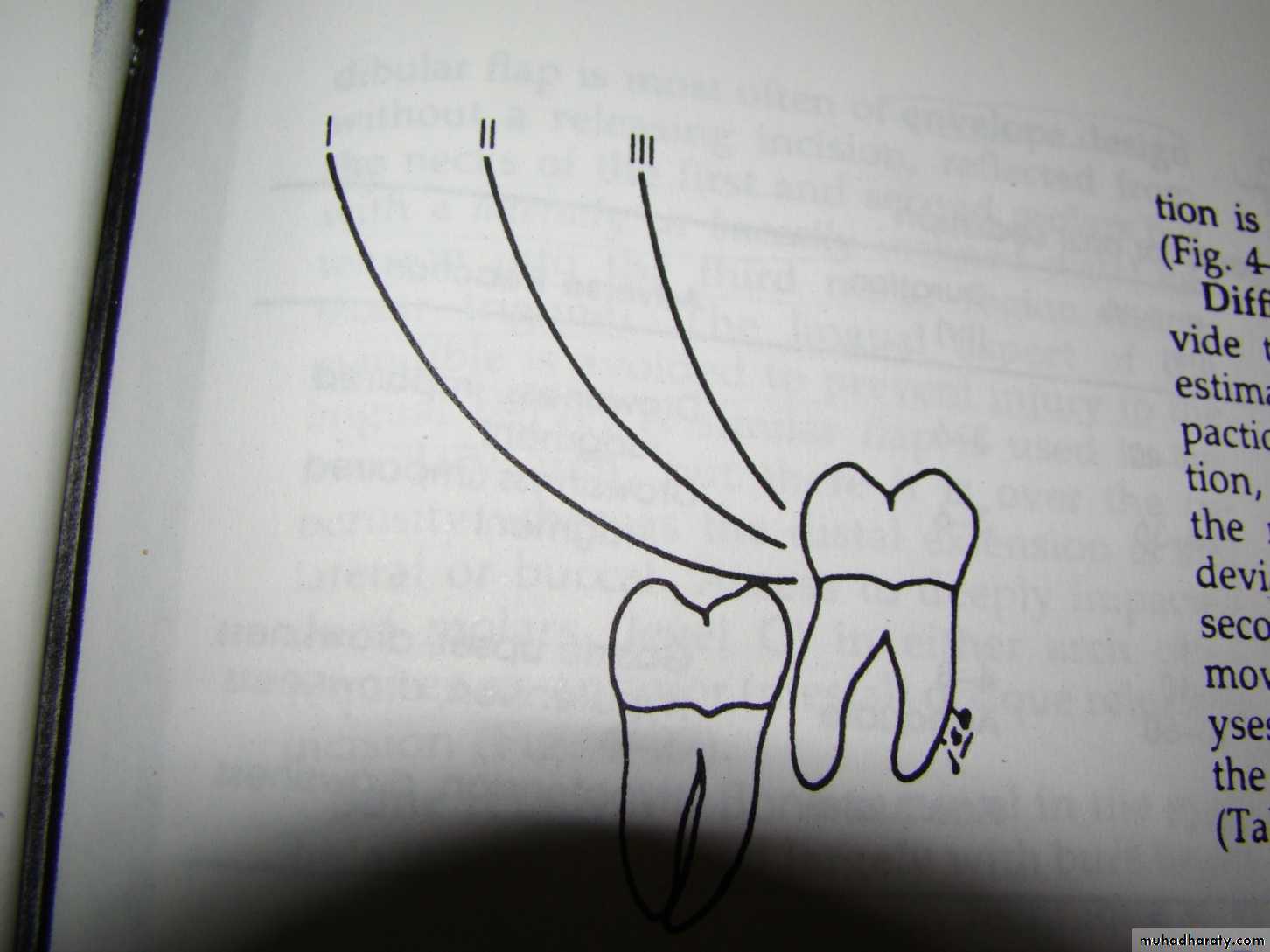 Impaction