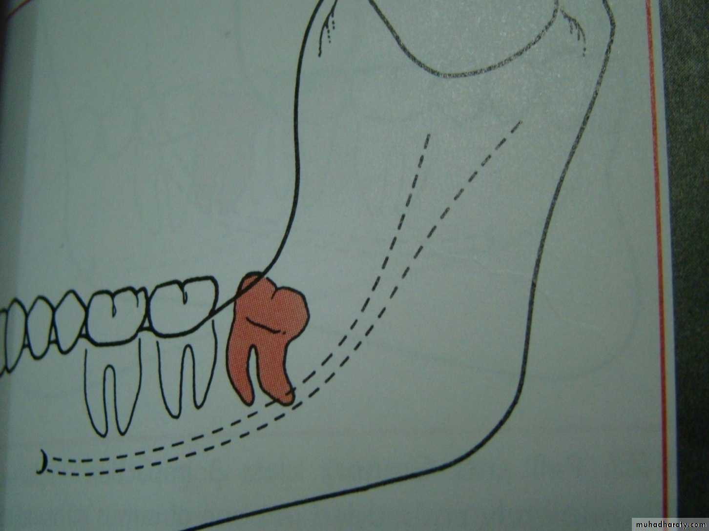 Impaction