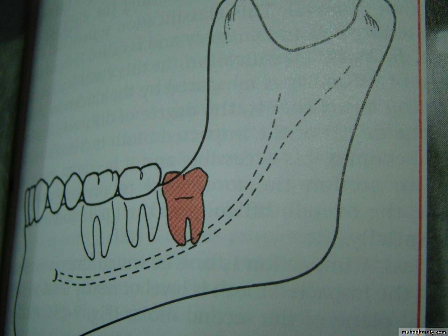 Impaction