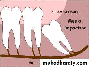 Impaction
