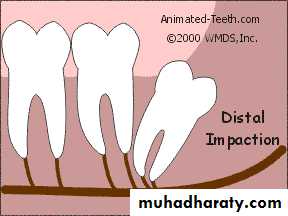 Impaction