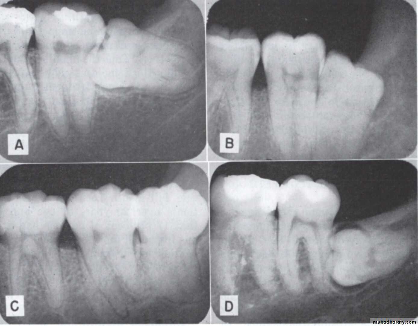 Impaction