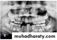 Impaction