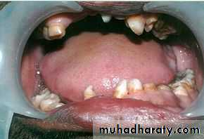 Impaction