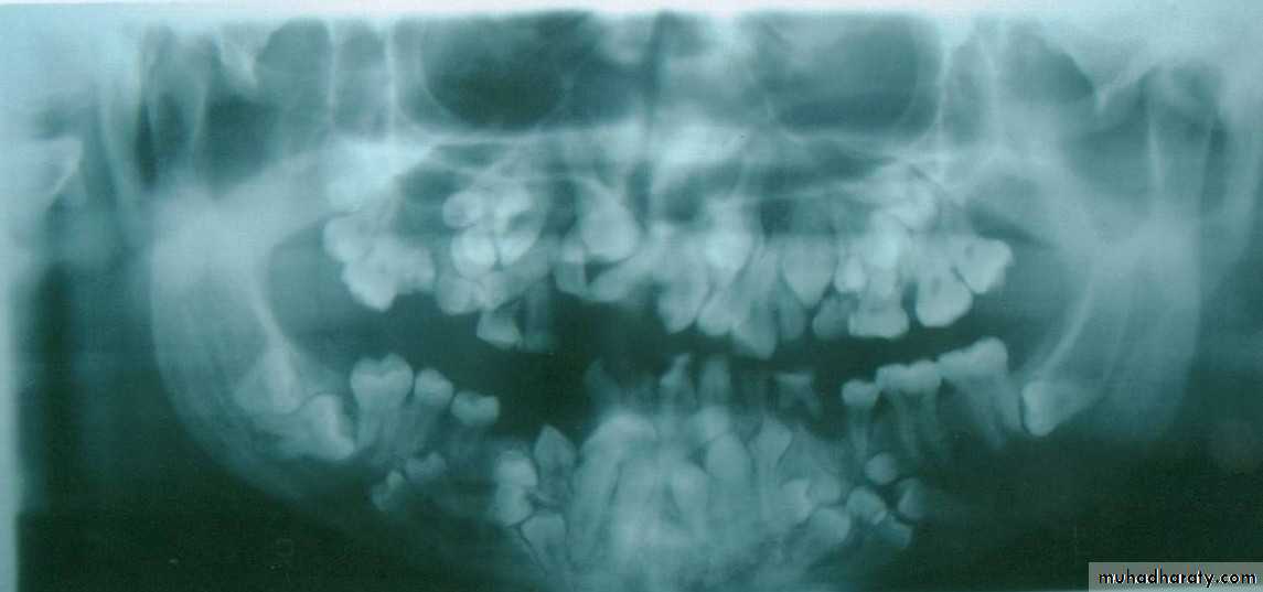 Impaction