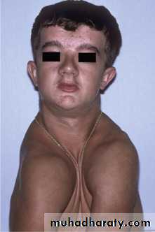 Impaction