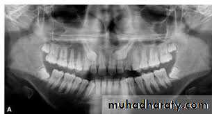 Impaction