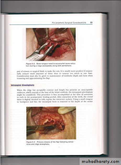 Pre-prosthetic surgical considerations