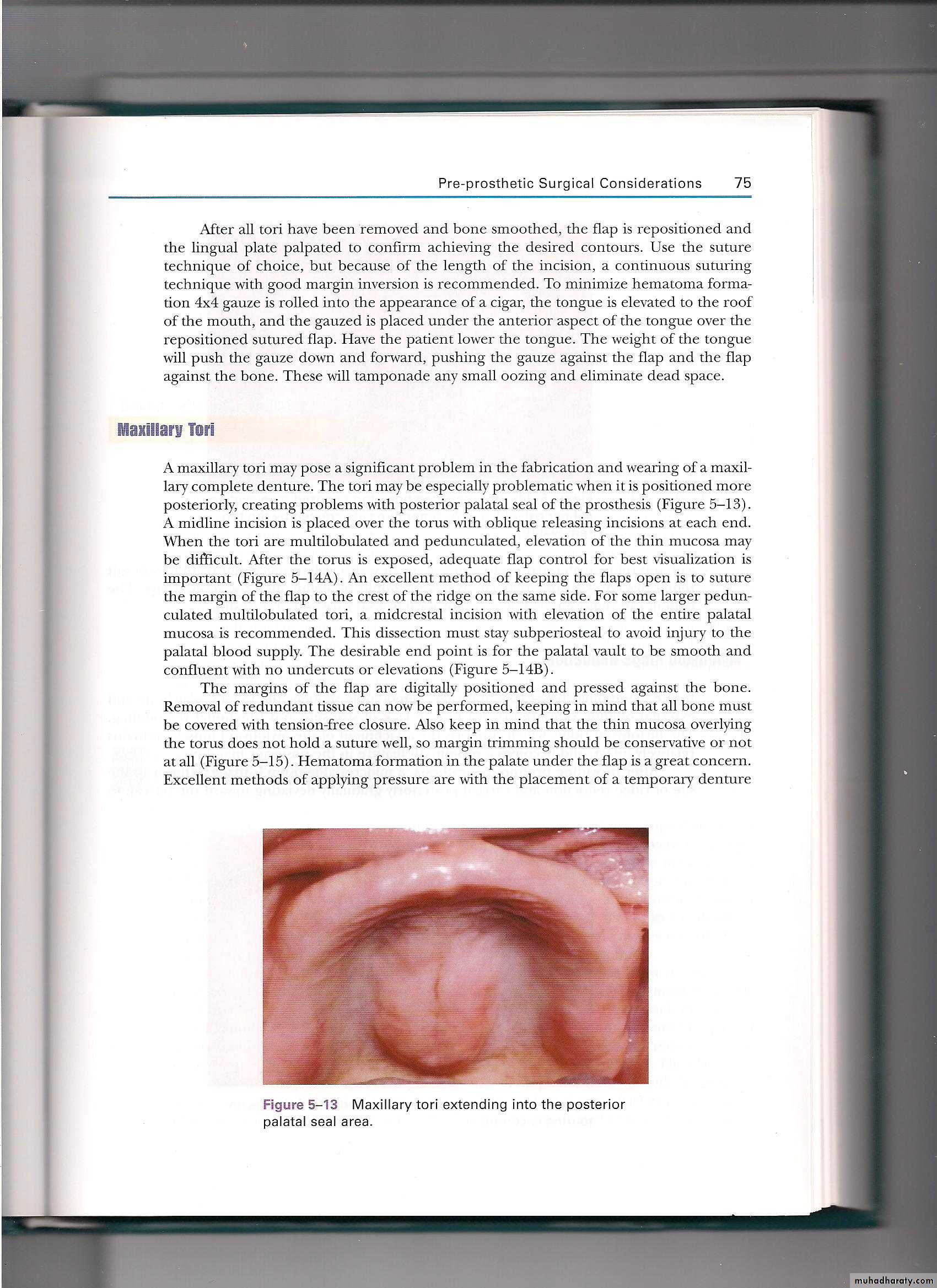 Pre-prosthetic surgical considerations