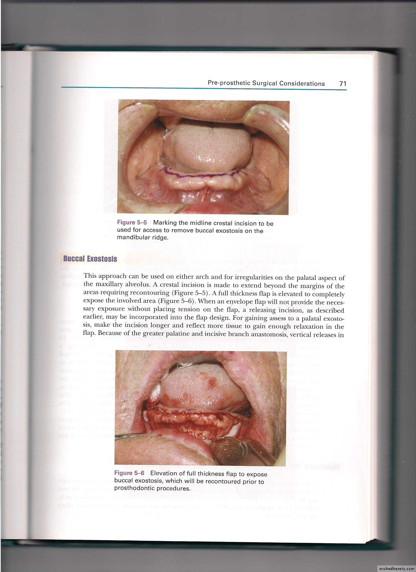 Pre-prosthetic surgical considerations