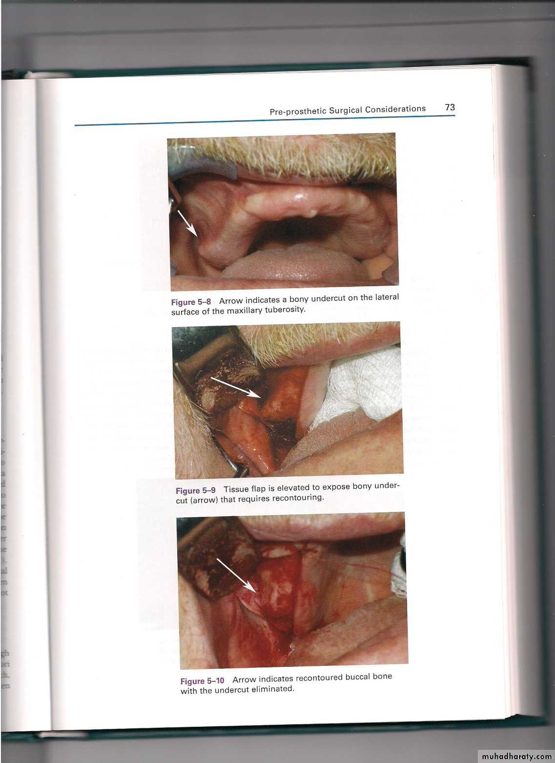 Pre-prosthetic surgical considerations