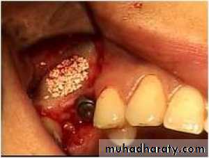 Pre-prosthetic surgical considerations