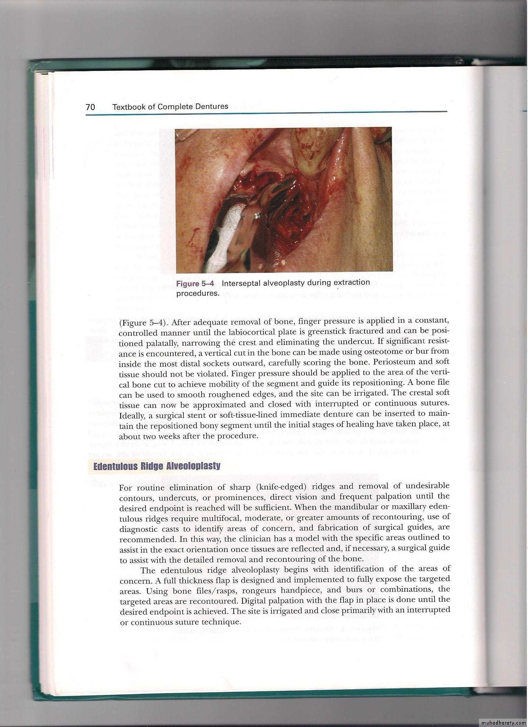 Pre-prosthetic surgical considerations