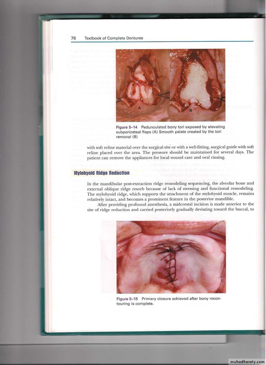 Pre-prosthetic surgical considerations