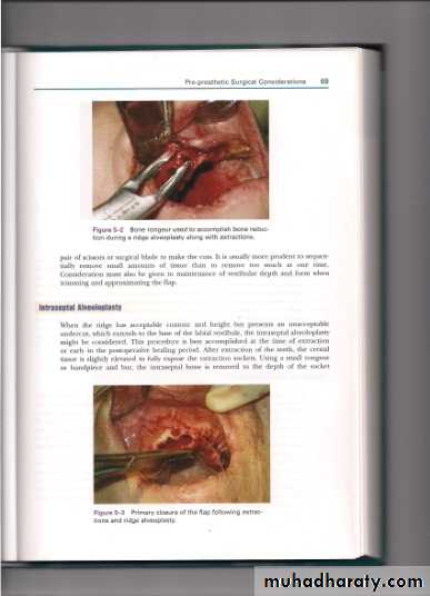 Pre-prosthetic surgical considerations