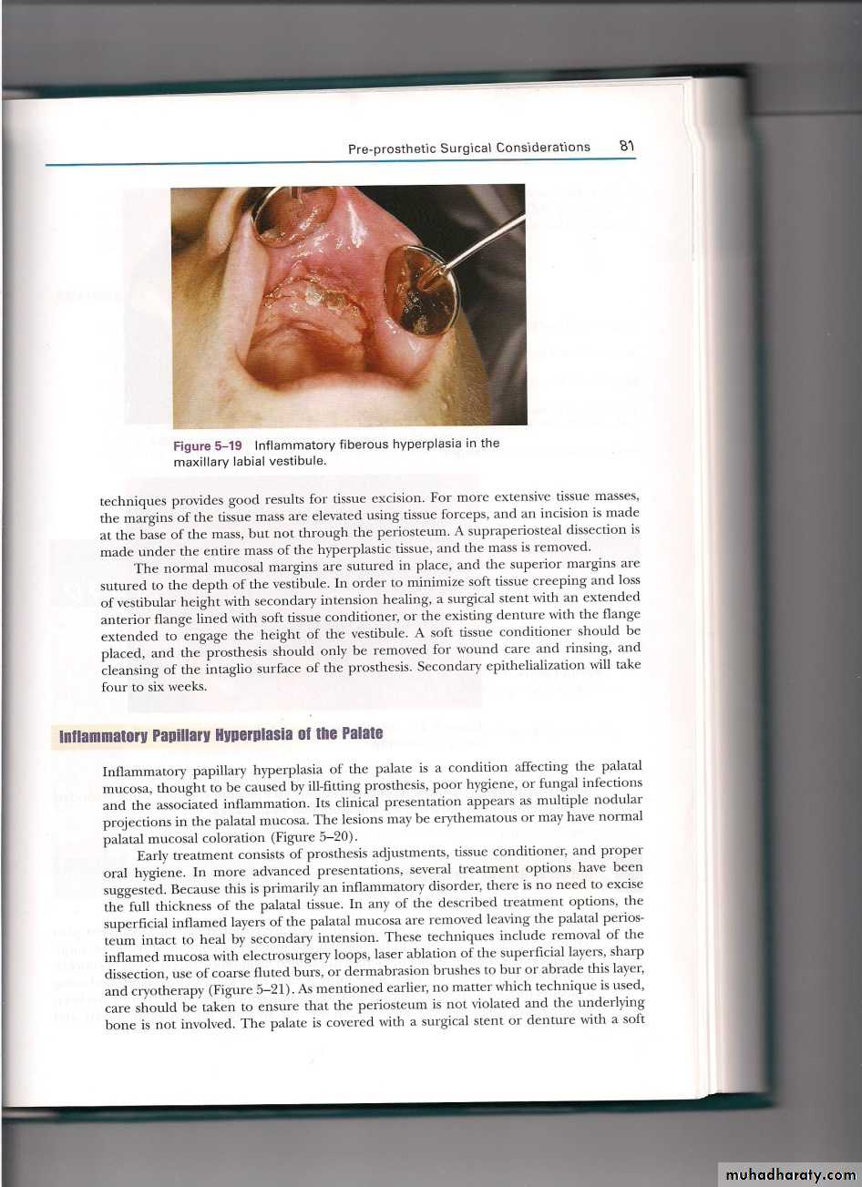 Pre-prosthetic surgical considerations