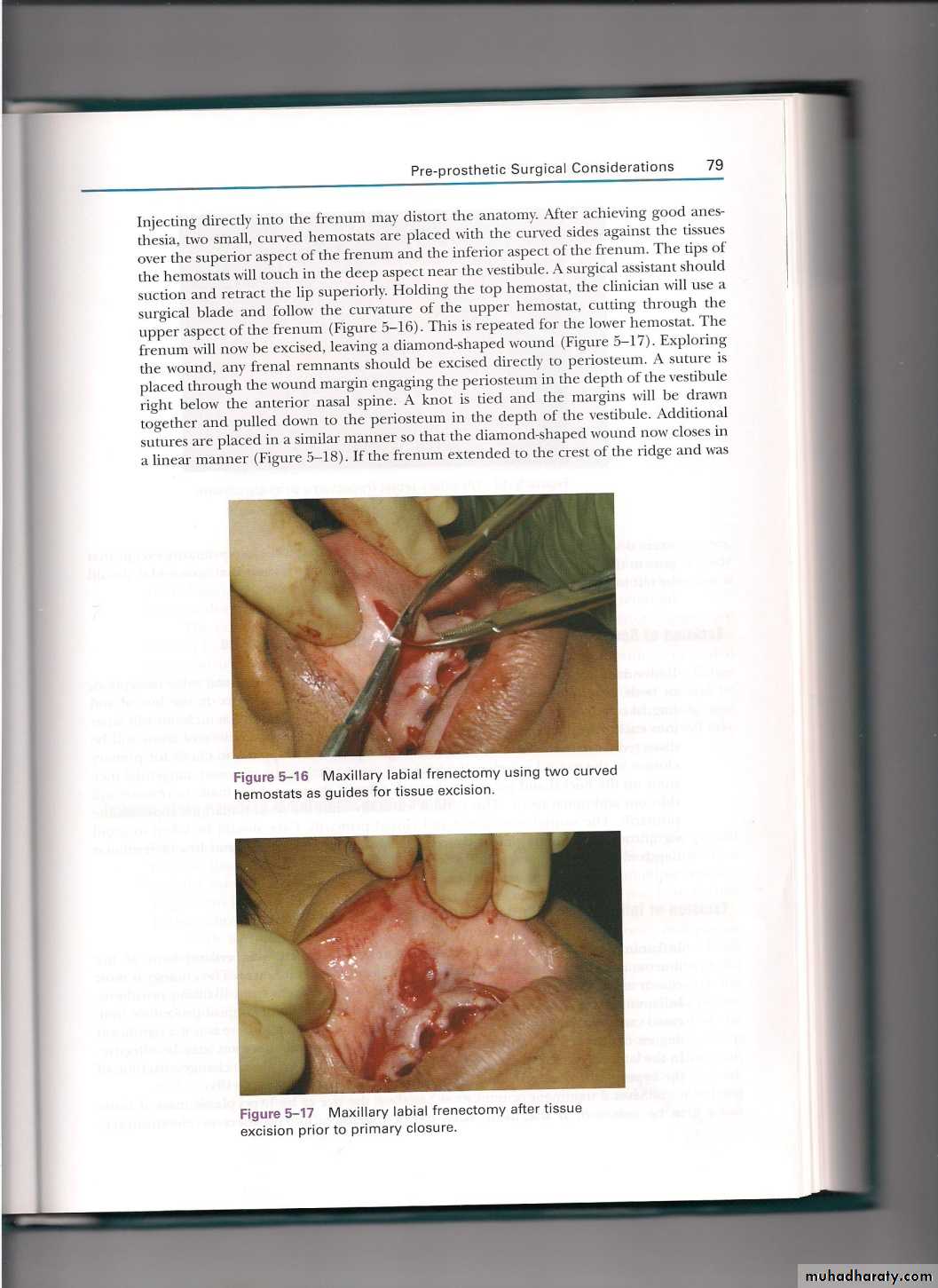 Pre-prosthetic surgical considerations