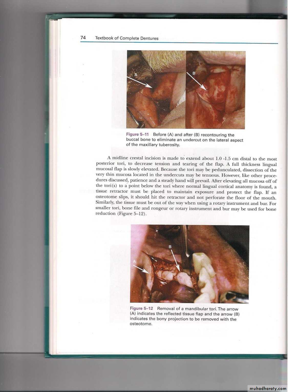 Pre-prosthetic surgical considerations