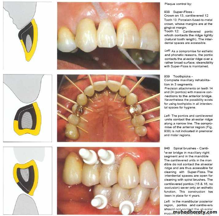 The predisposing factors for periodental diseases