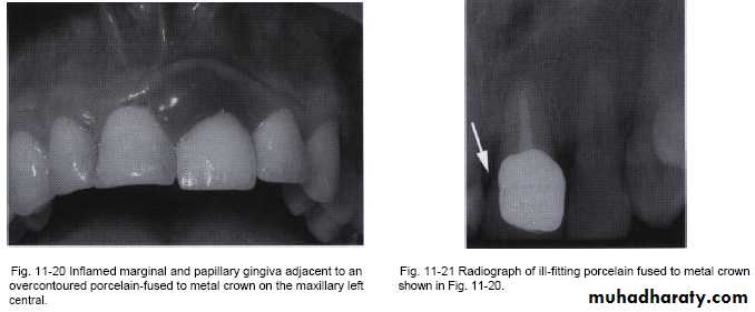 The predisposing factors for periodental diseases