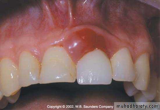 The predisposing factors for periodental diseases