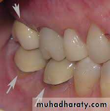 The predisposing factors for periodental diseases