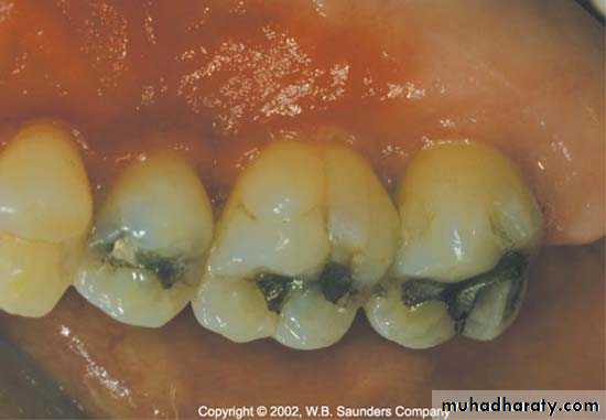 The predisposing factors for periodental diseases