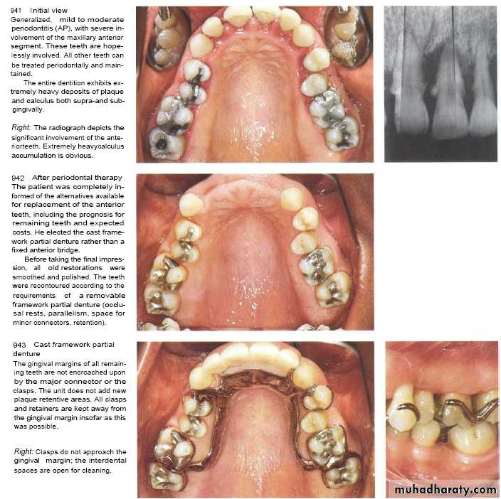 The predisposing factors for periodental diseases