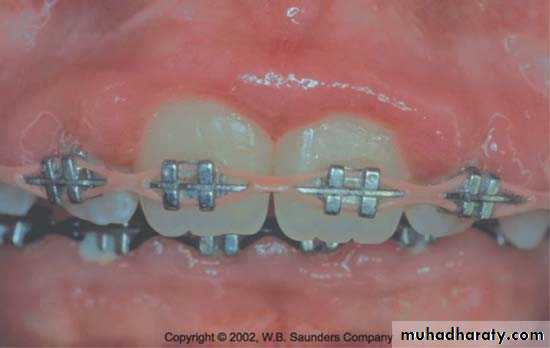 The predisposing factors for periodental diseases